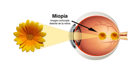 Alargamiento excesivo del ojo una de las principales causas de la miopía en niños