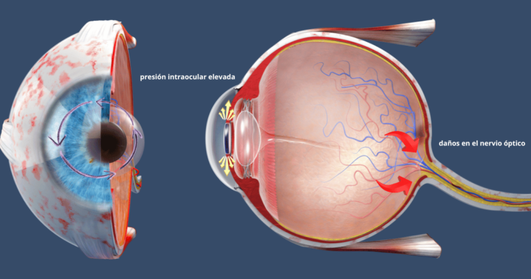que es el glaucoma