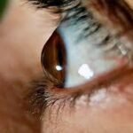 ¿Qué es el queratocono? Causas, síntomas y tratamientos