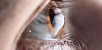 Queratocono ocular tratamiento con oftalmólogo al sur de Quito