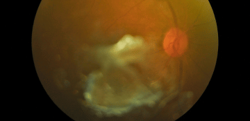 Tratamiento por oftalmólogo en el sur de Quito: Desprendimiento de retina